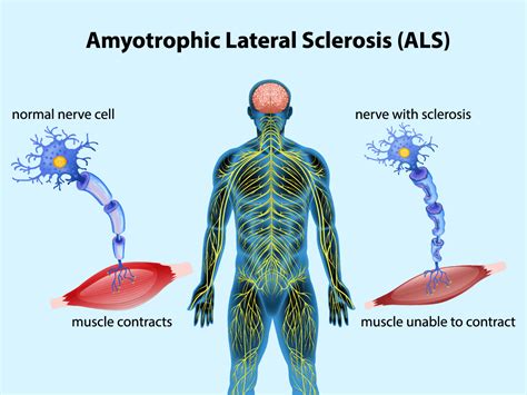 Risk factors for amyotrophic lateral sclerosis .